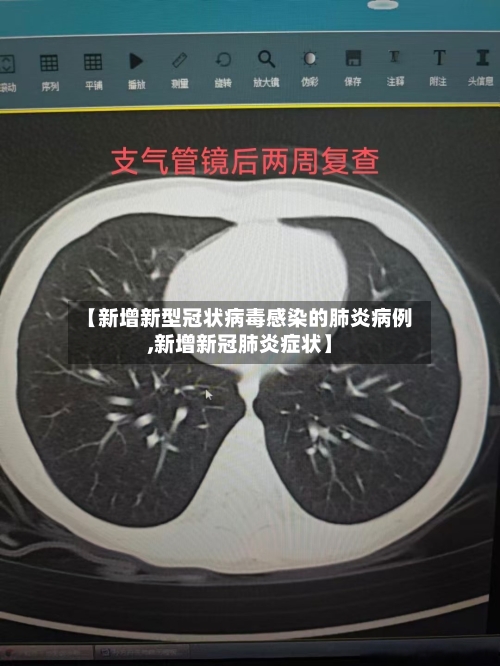 【新增新型冠状病毒感染的肺炎病例,新增新冠肺炎症状】-第2张图片